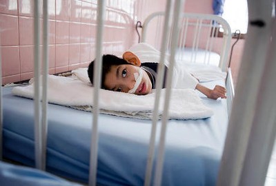 Wajah Malang Anak-anak Korban Perang Vietnam yang Cacat karena Racun Kimia