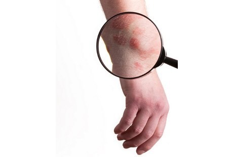 Jika Sudah Telanjur Parah, Selulitis pun Harus Dioperasi