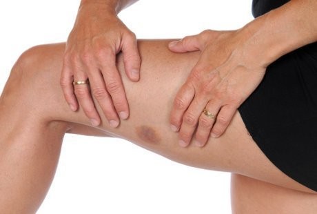 Daftar Penyebab Lebam dan Memar Dijilat Setan