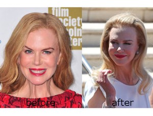 Wajah Nicole Kidman Bengkak Saat di Red Carpet Festival Film Cannes