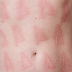 Bentol-Bentol di Badan Jadi Medium Seni