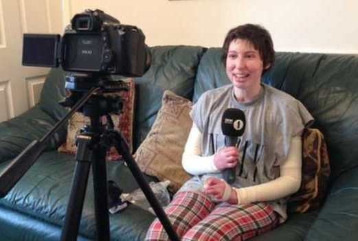 Seluruh Tubuh Terbakar dan 3 Bulan Koma, Kini Catrin Kembali Jelita