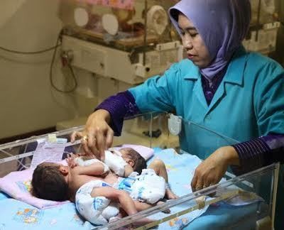 Bayi Kembar Siam Dempet Dada dan Perut Lahir di Ponorogo