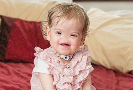 Kisah Tessa, Bocah yang Terlahir Tanpa Hidung dan Tak Bisa Mencium Bau