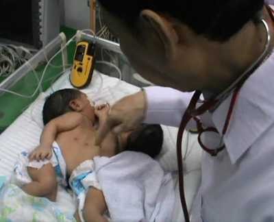 RSU Soetomo Rawat Bayi Kembar Siam Sahrini-Sahrina Asal Jember