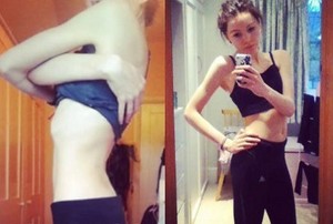 Berbobot Hanya 38 Kg, Mahasiswi Anoreksia Ini Sembuh Berkat Terapi Selfie