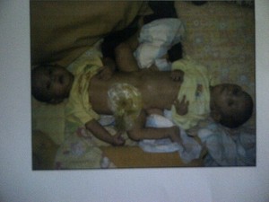 RSHS Rawat Bayi 20 Bulan Kembar Siam Dempet Bokong