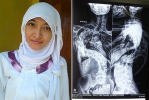 Perjuangan Ardha, Gadis Mojokerto Melawan Skoliosis 144 Derajat