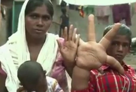Kelainan Langka, Bocah 8 Tahun di India Punya Tangan Raksasa Seberat 8 Kg