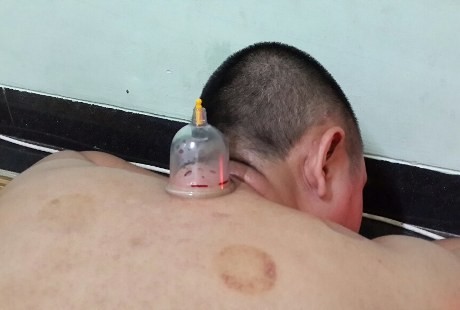 Perlu Ada Sertifikasi Kompetensi, Tak Semua Orang Bisa Buka Praktik Bekam