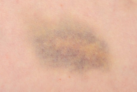 Gejala Hemofilia Sulit Dikenali, Waspada Jika Bayi dan Balita Mudah Lebam