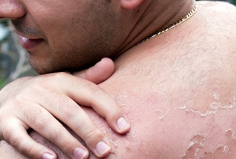 Akibat Terlalu Bersih, Manusia Kini Lebih Rentan Alergi