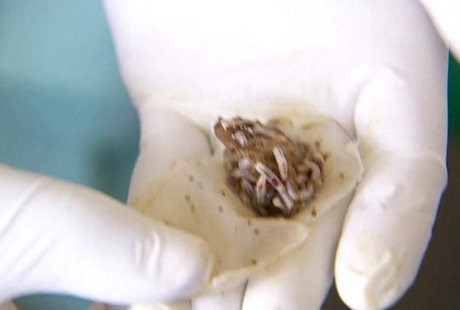 RS di Kenya Manfaatkan Belatung untuk Percepat Penyembuhan Luka