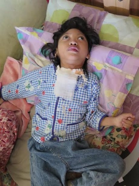 Mega Bocah Lumpuh Otak Ini Bernapas dengan Lubang di Leher