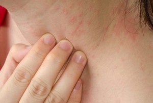 Sedang Sakit Cacar Air, Boleh Mandi atau Tidak?