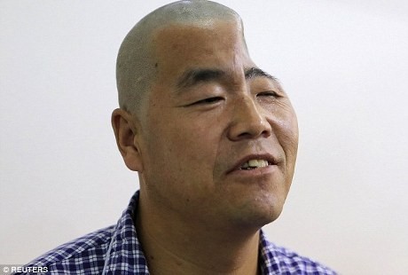 Sempat Separuh Cekung karena Jatuh, Kepala Hu Kini Utuh Berkat Operasi 3D