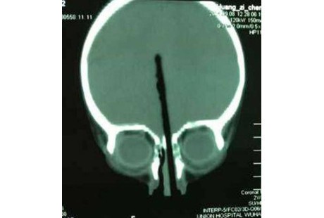 Ya Ampun! Hidung Bocah 2 Tahun Tertusuk Sumpit Hingga Tembus ke Tengkorak