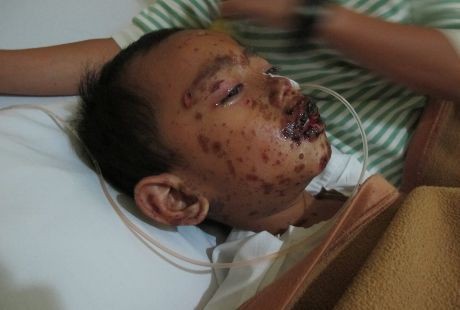 Kulit Bocah 5 Tahun Ini Melepuh Akibat Sindrom Langka