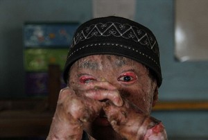 Ari Wibowo, Remaja Asal Tangerang yang Mendunia karena Berkulit Ular