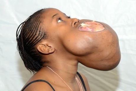 Tumor Sebesar Bola Sepak Tumbuh di Rahang Remaja asal Kongo