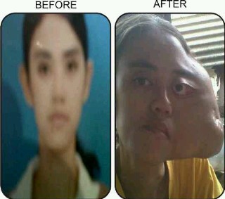 Kisah Anggi dan Tumor Ganas yang Merenggut Kecantikannya