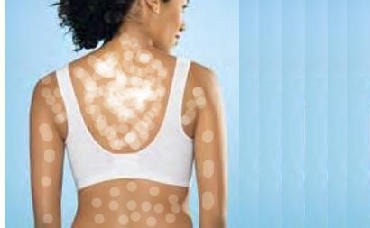 Oli Bekas dan Cara Unik Lainnya yang Dipercaya Manjur Sembuhkan Panu