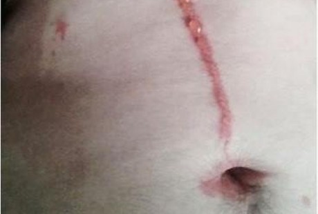 Sepulang dari Bali, Ada Laba-laba Hidup di Kulit Pria Australia Ini