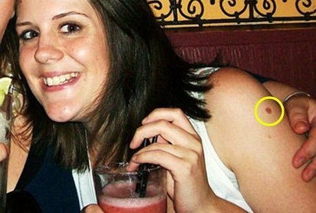 Siapa Sangka, Tahi Lalat di Lengan Natasha Ternyata Tanda Kanker Kulit