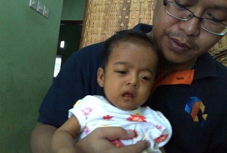 Dokter: Pengobatan untuk Atresia Bilier Hanya Bisa dengan Transplantasi