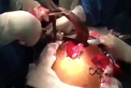 Hii, Dokter Keluarkan Ikan Hidup dari Perut Pria Ini