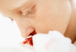 Apakah Mimisan Bisa Sebabkan Kematian?