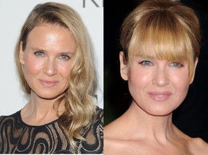 Takut Gagal Botox Seperti Renee Zellweger, Wanita Mulai Beralih ke Notox