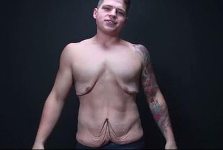 Diet Ekstrem, Kulit Pemuda Ini Menggelambir dan Bisa Ditarik Sampai Melar