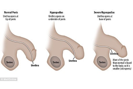 Kelainan Langka Ini Bikin Pria Tak Bisa Pipis dari Ujung Penis