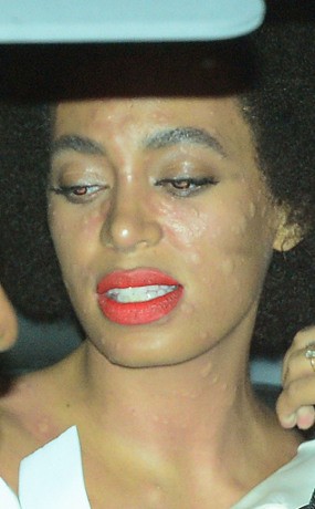 Usai Resepsi Pernikahan, Wajah Solange Knowles Bentol-bentol