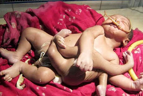 Lahir dengan Empat Kaki dan Tangan, Bayi Ini Bikin Heboh India