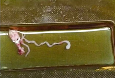 Jajan Sembarangan, Bocah 11 Tahun Terinfeksi Cacing Parasit di Otaknya