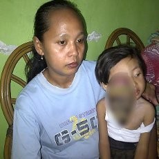 Fadil, Bocah 3 Tahun Penderita Tumor Mata Ganas Dirujuk ke RSU Soetomo