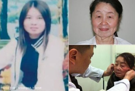 Sindrom Langka: Umur Baru 29 Tahun, Wajah Seperti 80 Tahun