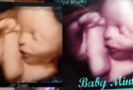 Jual Foto USG yang Sama ke Pelanggan, Wanita Australia Dituding Menipu