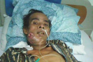 Tolong! Seorang Pemulung di Bekasi Butuh Biaya untuk Operasi Tumor Mulut