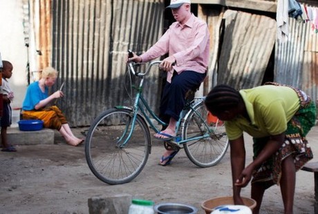 Dipercaya Berkhasiat, Kaum Albino Tanzania Diburu untuk Diambil Organnya