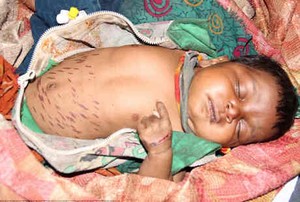 Bayi di India Ini Dicap Pisau Panas untuk Sembuhkan Pneumonia