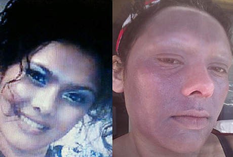 Kulit Melepuh Karena Sakit Misterius, Shabana 20 Tahun Tak Keluar Rumah