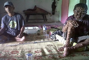 Manusia Penuh Tumor dari Magetan yang Menarik Perhatian Media Asing