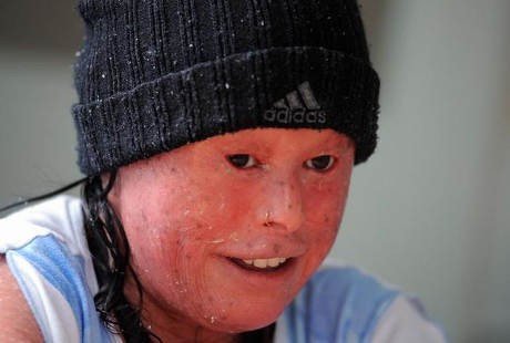 Nelly Berjuang Hidup dari Penyakit Langka yang Bikin Wajahnya Bersisik