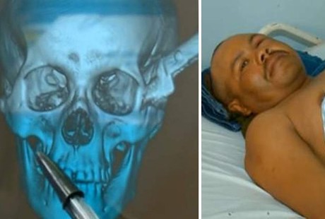 Kepala Tertusuk Pisau 30 Cm, Pria 39 Tahun Ini Masih Bisa Bertahan Hidup