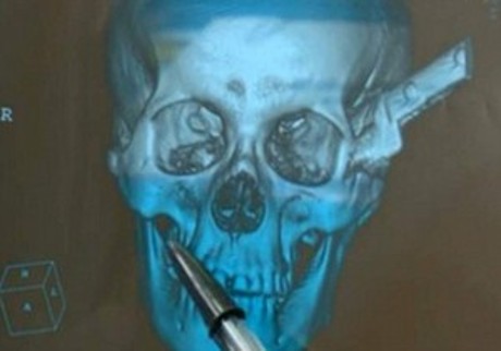 Ngerih, Pria Ini Kendarai Motor dengan Kepala Tertusuk Pisau