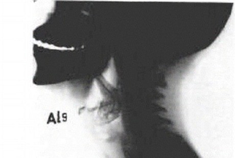 Belut Hidup 5 Jam Tersangkut di Tenggorokan, Remaja Ini Hampir Meninggal