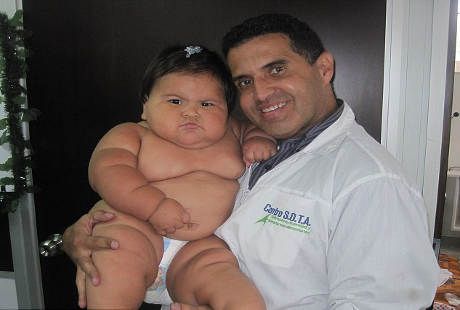 Sosok Juanita, Bayi asal Kolombia dengan Bobot 20 Kg